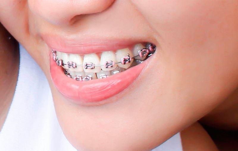 Ortodonti (Diş Teli Tedavisi)